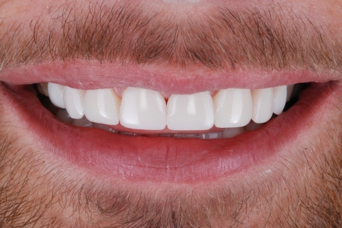 Composite veneers - Case 4 after