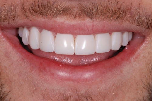 Composite veneers - Case 5 after