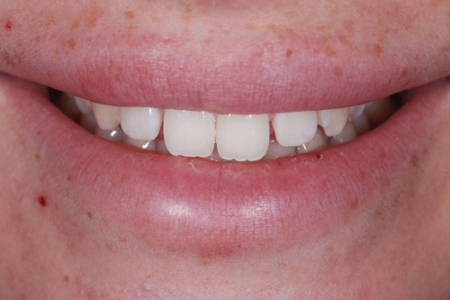 Composite veneers - Case 6 before