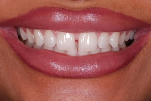 Composite veneers - Case 9 before