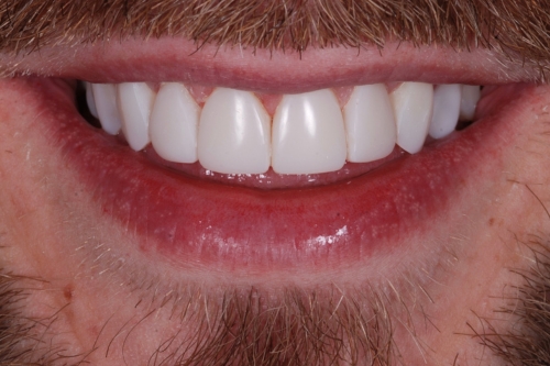Composite veneers - Case 10 after