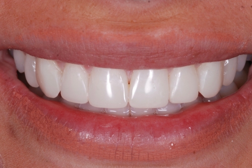 Edge bonding - Case 4 after