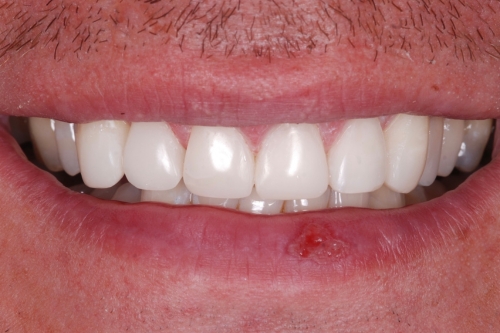 Edge bonding - Case 6 after