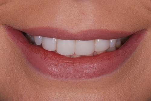 Invisalign rejuvenate package - Case 4 before