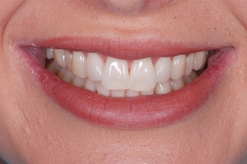 Invisalign enhance package - Case 4 before