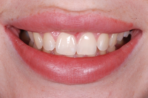 Invisalign enhance package – Case 5 before