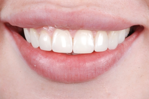 Invisalign enhance package – Case 5 after