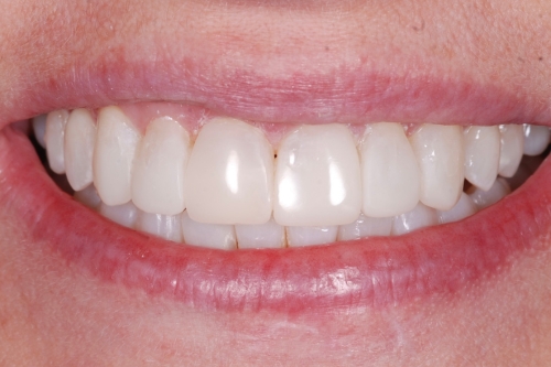 Invisalign enhance package – Case 6 after