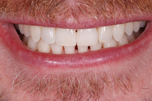 Invisalign enhance package – Case 7 after