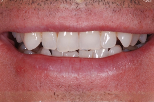 Invisalign enhance package – Case 8 before