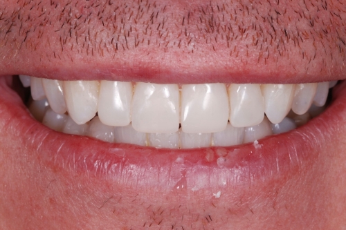 Invisalign enhance package – Case 8 after