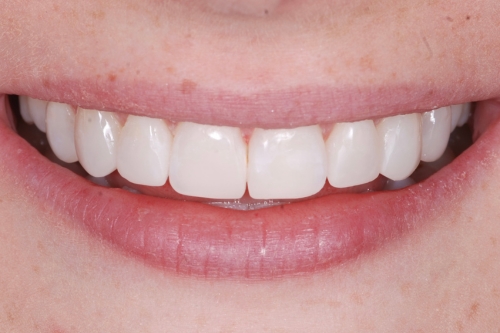 Invisalign enhance package – Case 9 after