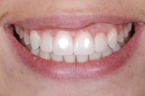 Invisalign enhance package – Case 10 after