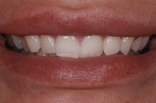 Invisalign enhance package – Case 11 before