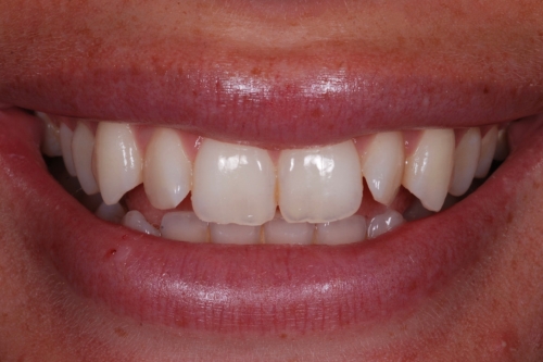 Invisalign enhance package – Case 12 before