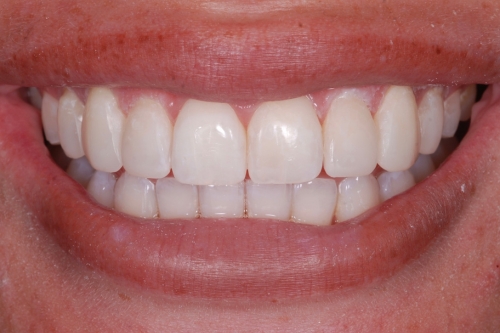 Invisalign enhance package – Case 12 after