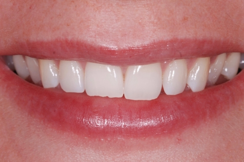 Invisalign enhance package – Case 13 before