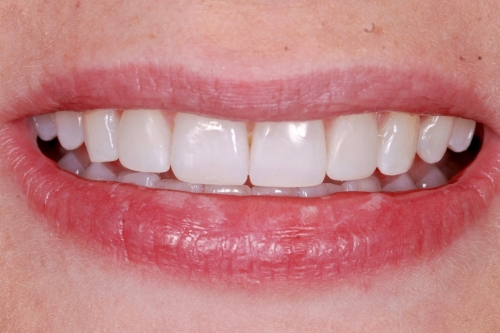 Invisalign enhance package – Case 13 after